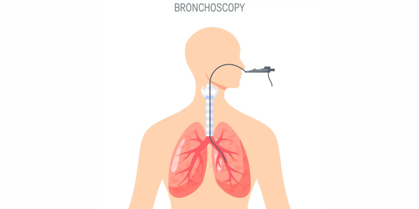 4 razloga kada trebate bronhoskopiju