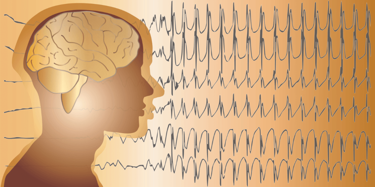 Epilepsija - simptomi, uzroci i komplikacije