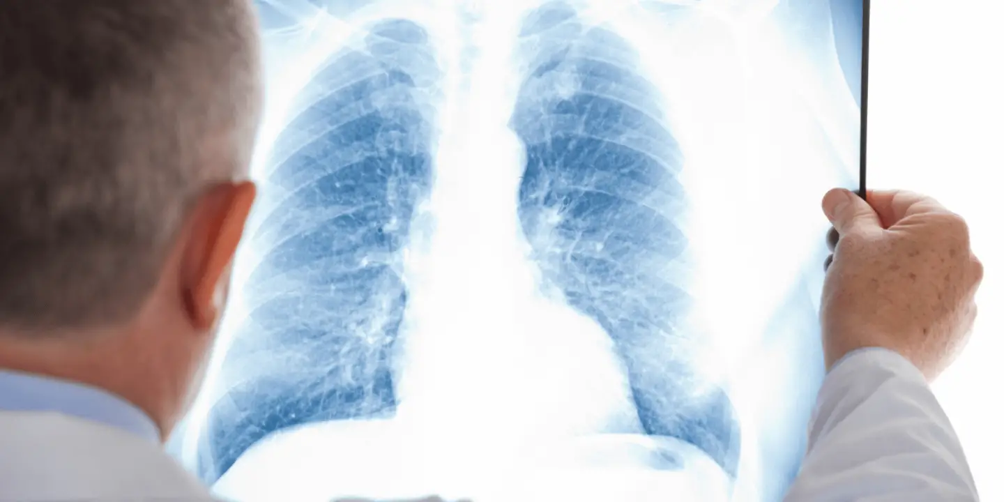 Upala pluća - simptomi, uzroci i prevencija