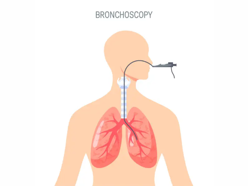 4 razloga kada trebate bronhoskopiju