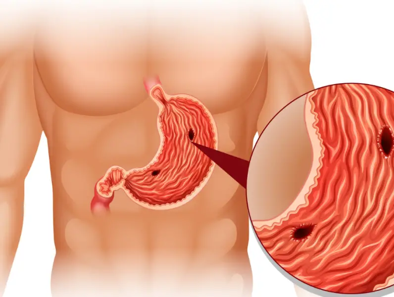 Čir na želucu - simptomi, uzroci i komplikacije