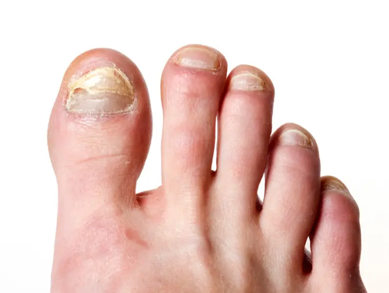 Kako dermatolozi dijagnosticiraju gljivice na noktima?