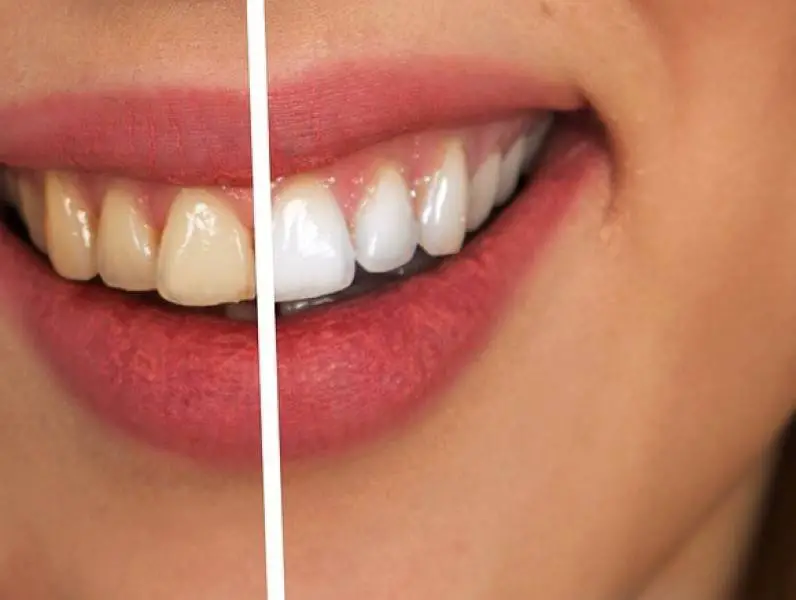 8 stvari koje trebate znati prije izbjeljivanja zubiju