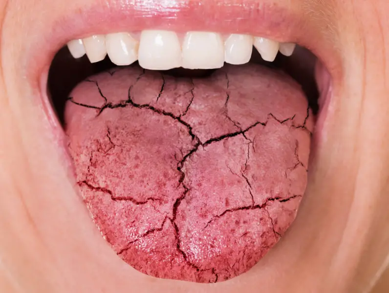 Koji su uzroci suhih ustiju i kako se boriti s ovim stanjem
