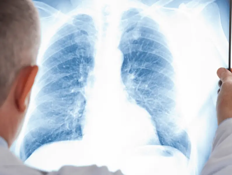 Upala pluća - simptomi, uzroci i prevencija